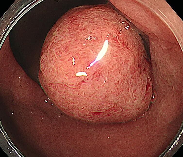 大腸ポリープ、見つけるだけで終わらせない